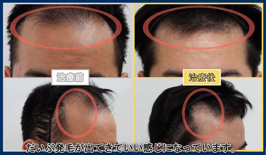 M字ハゲの薬を1年飲んだ後のM字の改善